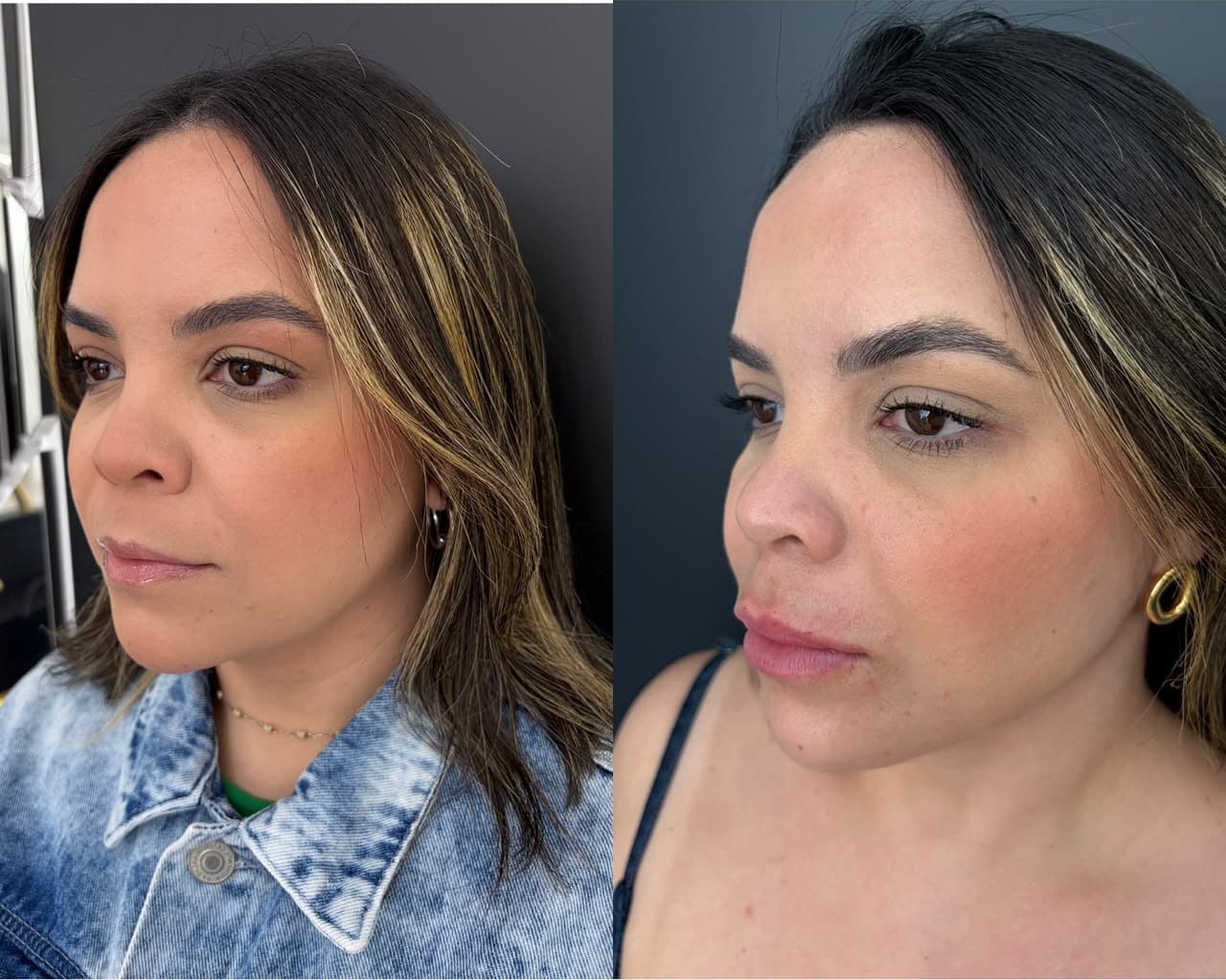 Antes e depois de harmonização facial em perfil três quartos, com toxina botulínica, sustentação do malar, preenchimento labial e ângulo da mandíbula mais definido.